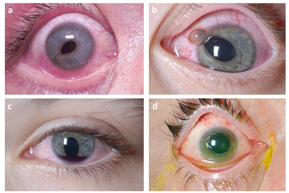 Cataract Phaco Surgeon in pune