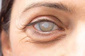 Cataract Treatment in pune