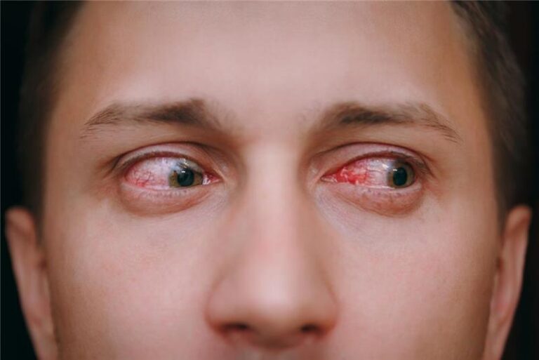 red eye